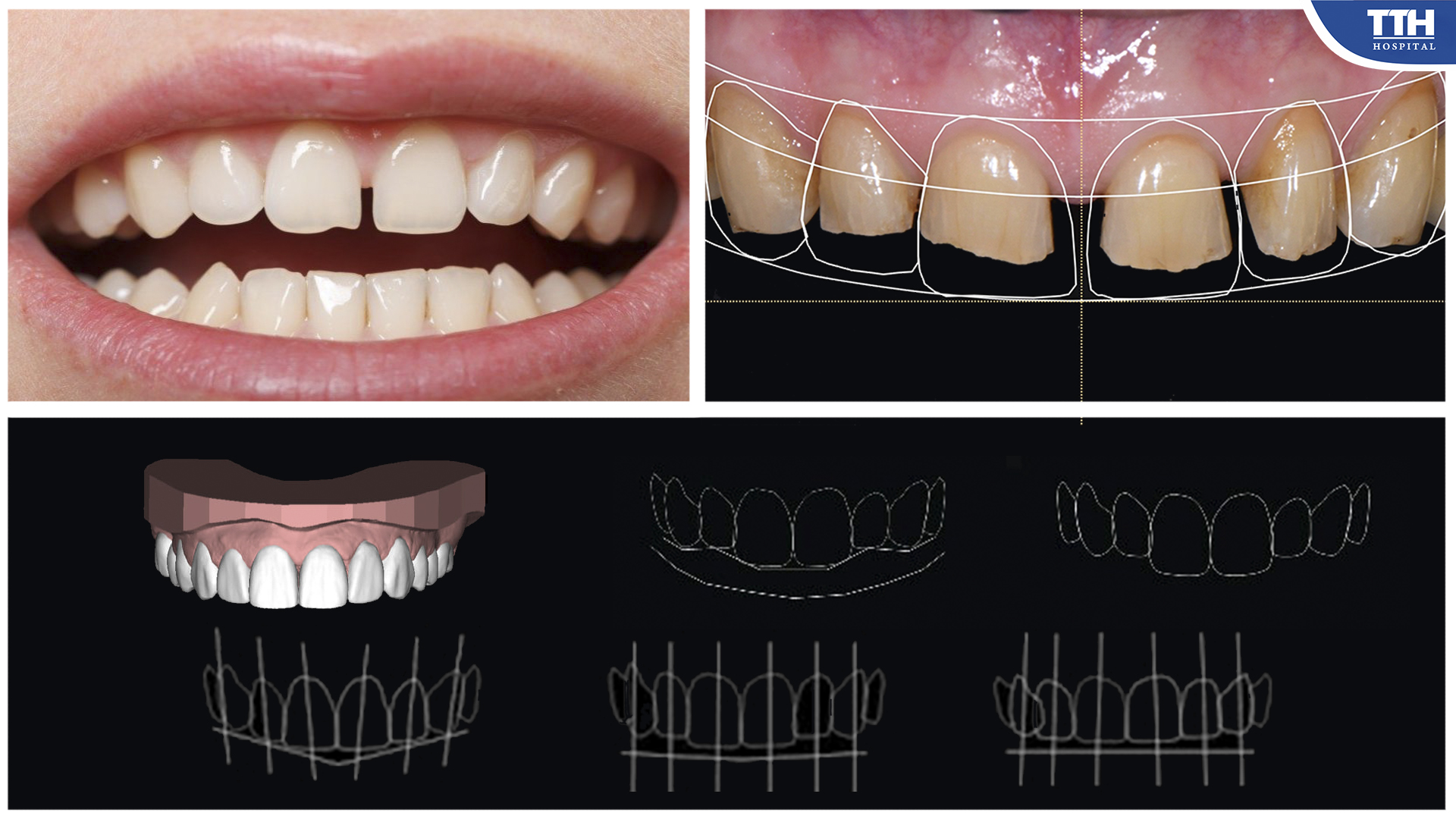 Thiết kế nụ cười dựa trên mong muốn của khách hàng