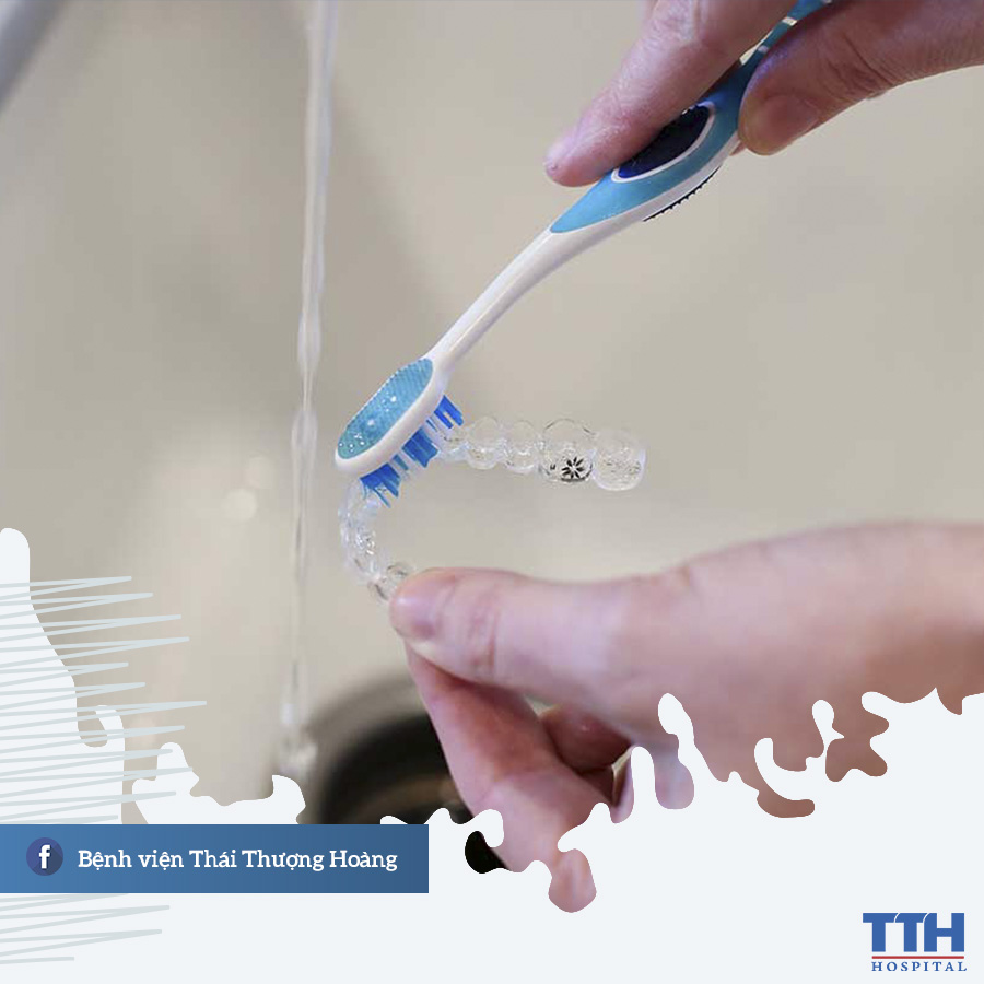 Rửa sạch khay niềng Invisalign sau mỗi lần tháo 