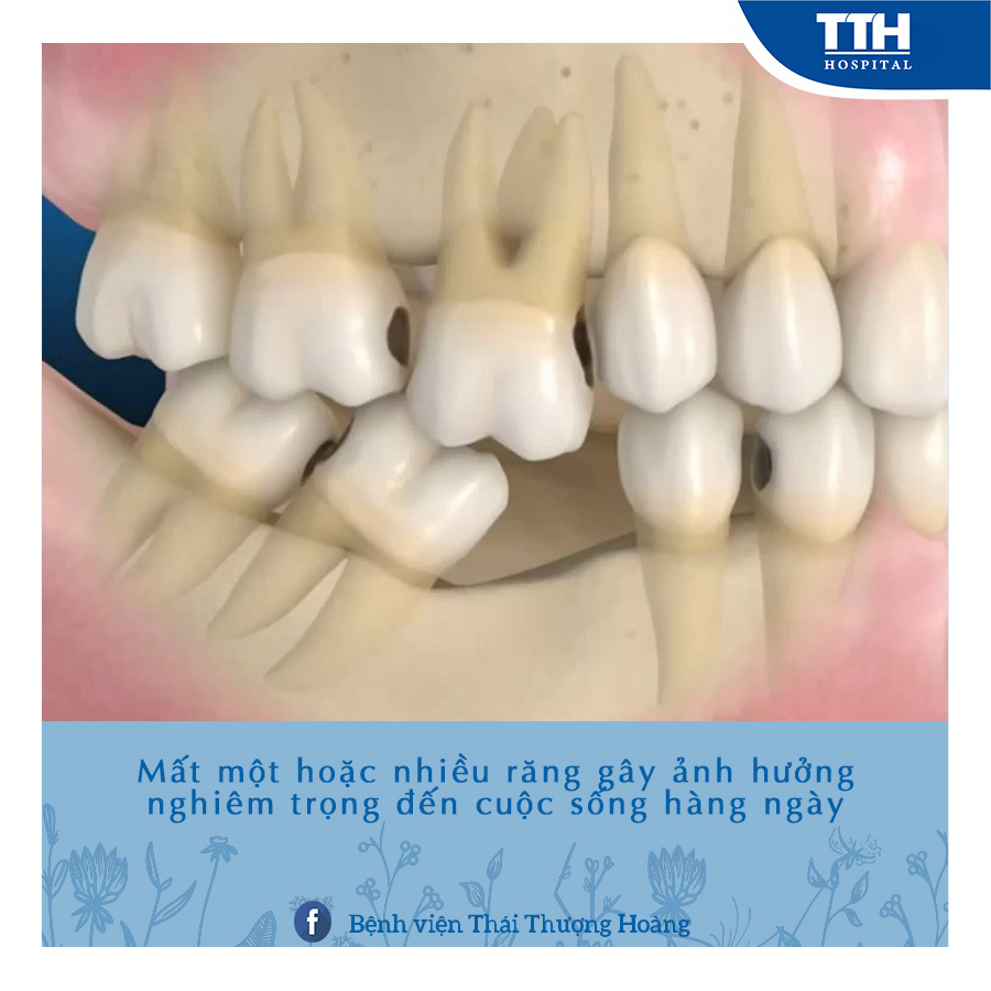 HẬU QUẢ CỦA TÌNH TRẠNG MẤT RĂNG
