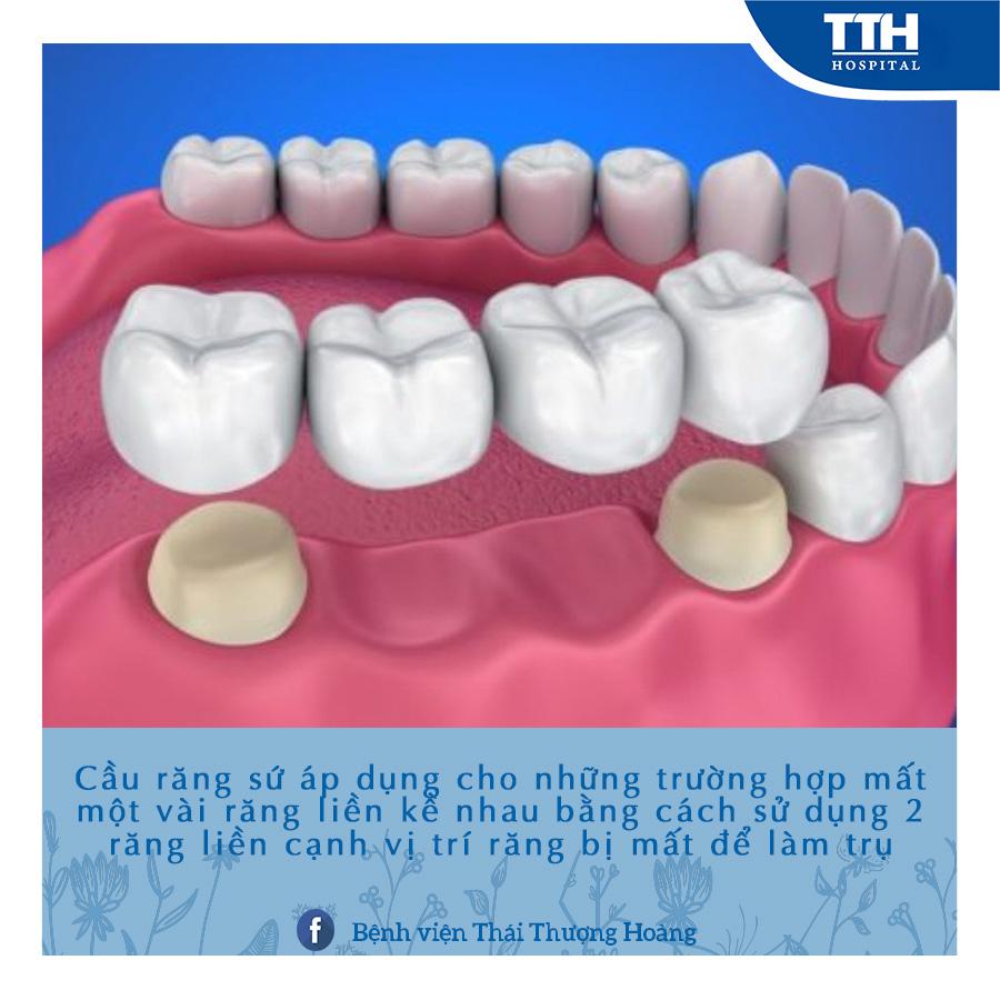 Cầu răng sứ được áp dụng cho những trường hợp mất một vài răng liền kề nhau bằng cách sử dụng 2 răng