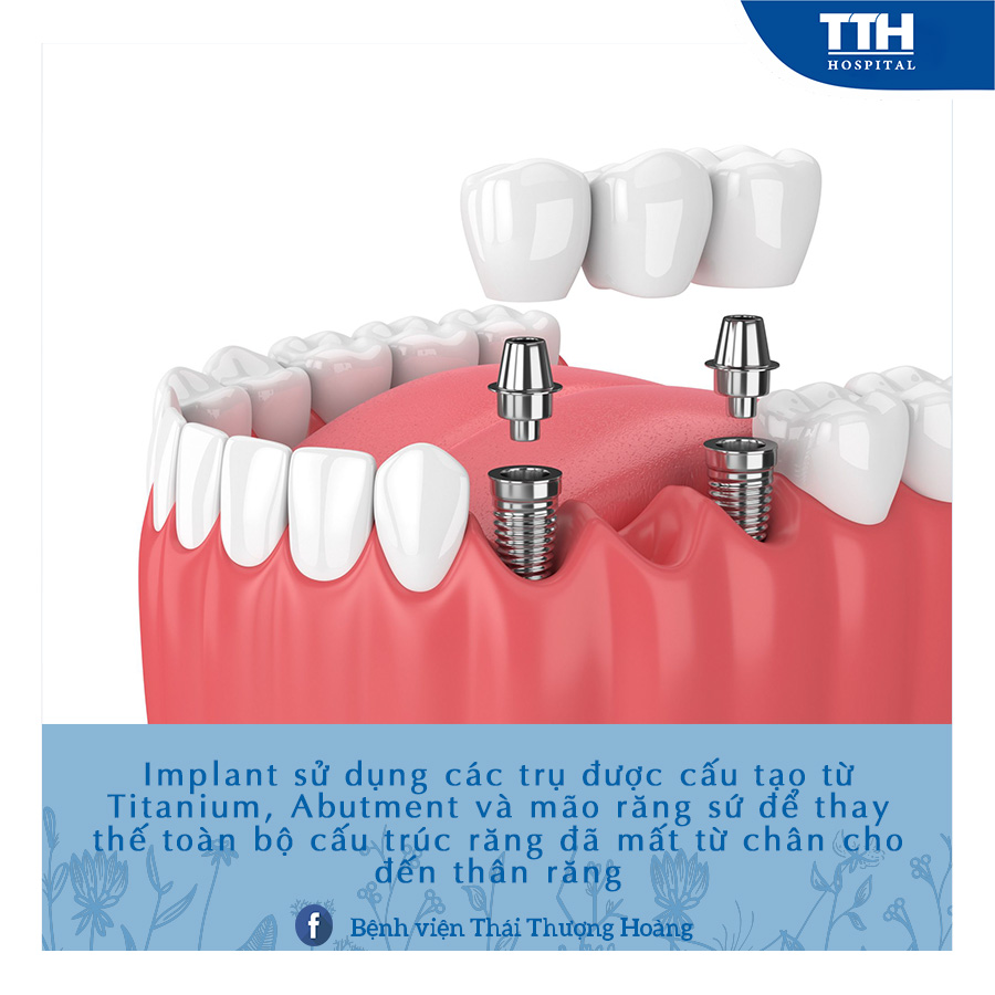 Cấy ghép Implant là phương pháp được sử dụng phổ biến hiện nay để khắc phục các tình trạng mất răng