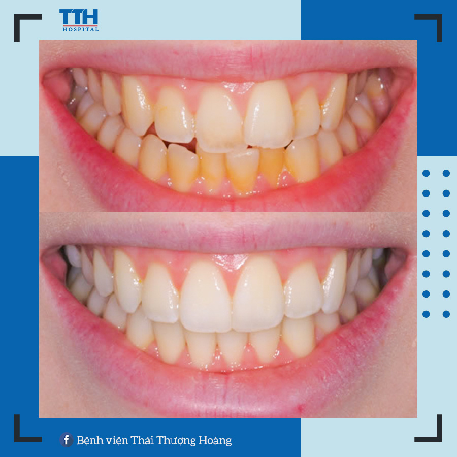 Kết quả không được như niềng răng mắc cài truyền thống