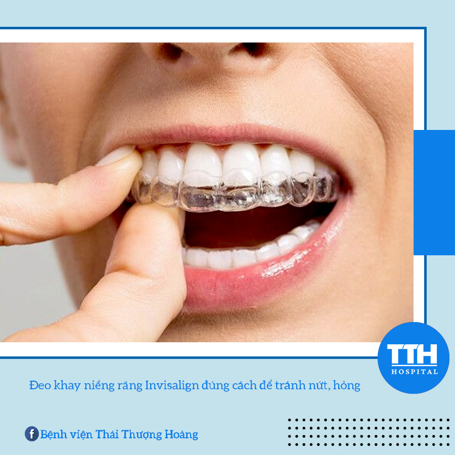 Bạn gặp khó khăn trong việc đeo, tháo khay niềng răng