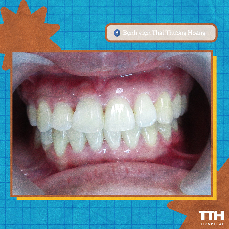 Invisalign đã mang lại cho tôi một nụ cười hoàn thiện hơn
