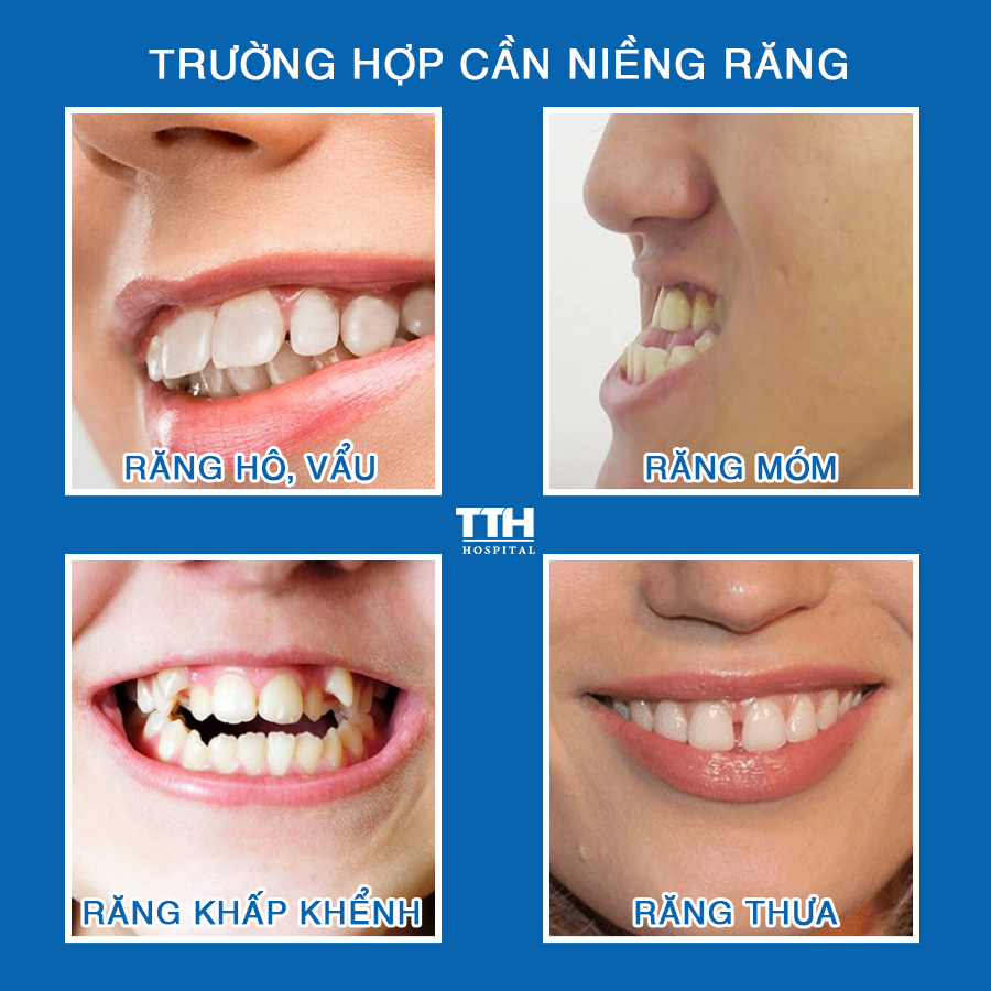 Một số thường hợp cần phải niềng răng