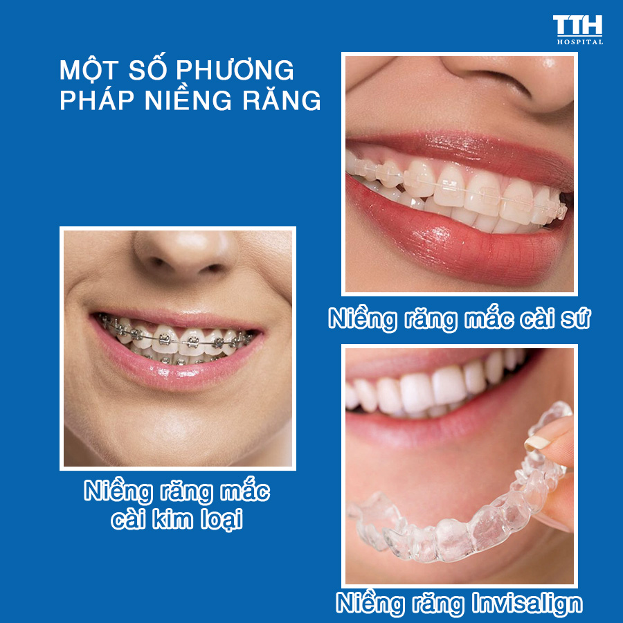 Một số phương pháp chỉnh nha phổ biến hiện nay