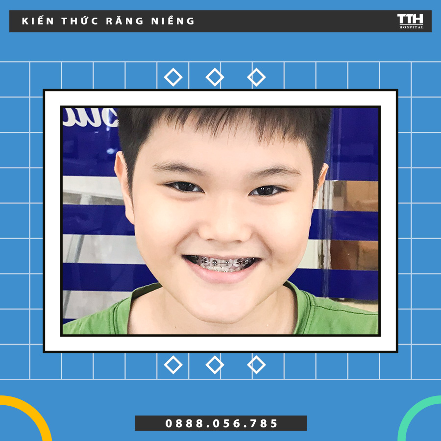 Niềng răng sớm giúp trẻ thêm phần tự tin trong cuộc sống
