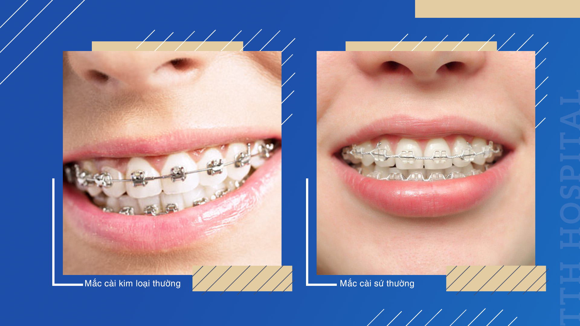 Niềng răng mắc cà truyền thống gồm 2 loại là mắc cài kim loại và mắc cài sứ