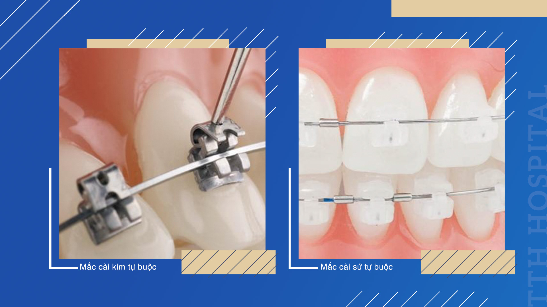 Niềng răng mắc cài tự buộc cũng được chia làm 2 loại là mắc cài tự buộc kim loại và mắc cài kim loại sứ