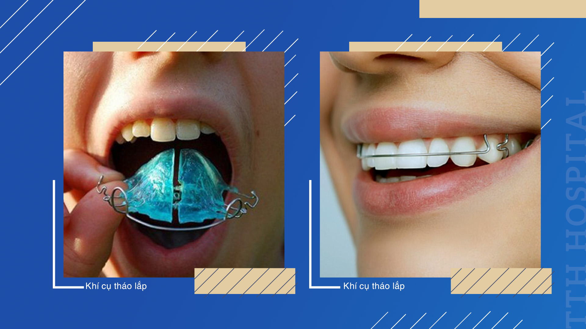 Khí cụ tháo lắp phù hợp với lứa tuổi từ 8 - 12