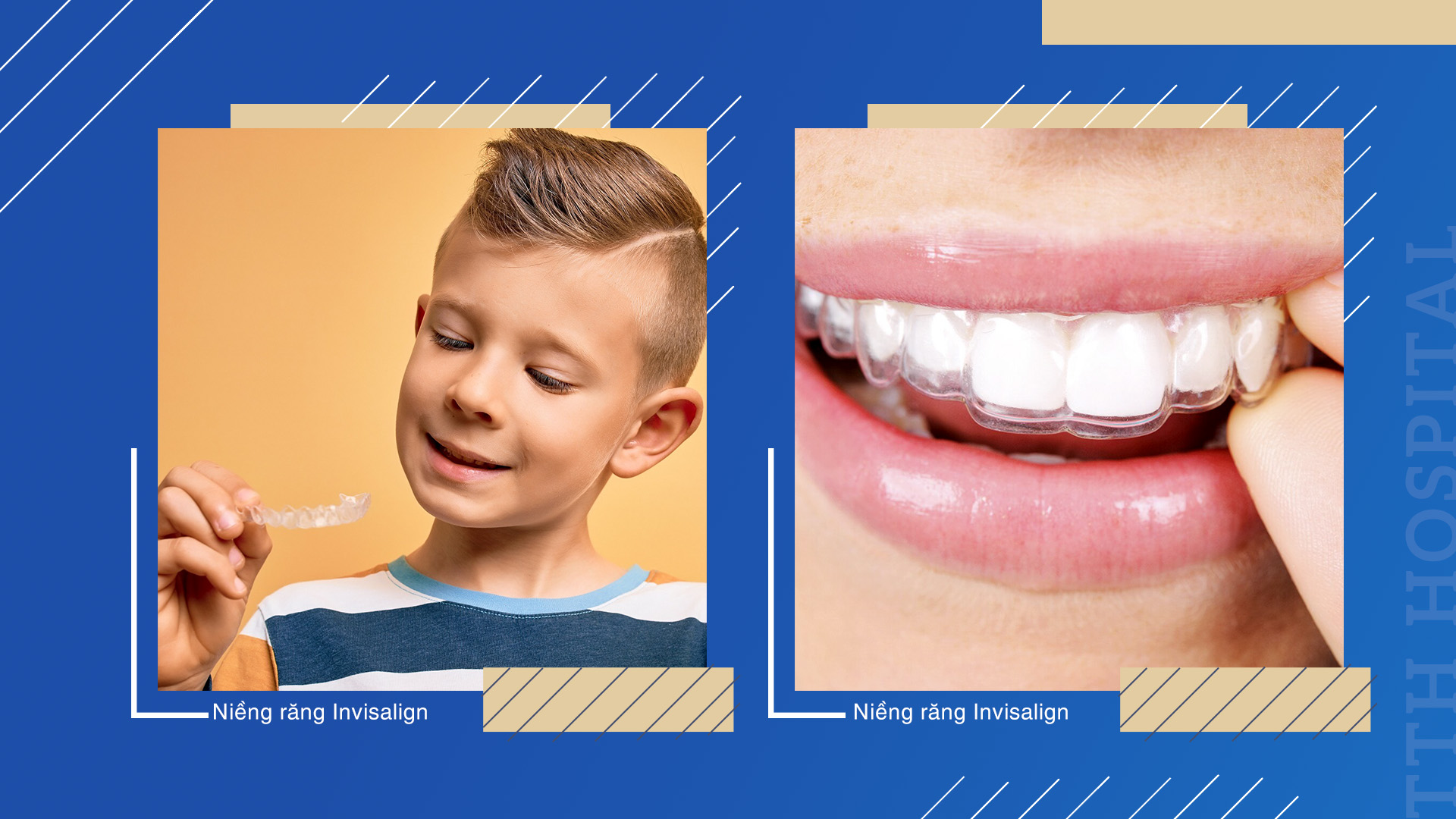 Niềng răng Invisalign đang dần trở thành xu hướng hiện nay với những ưu điểm vượt trội, phù hợp cho cả trẻ em, thanh thiếu niên và người lớn
