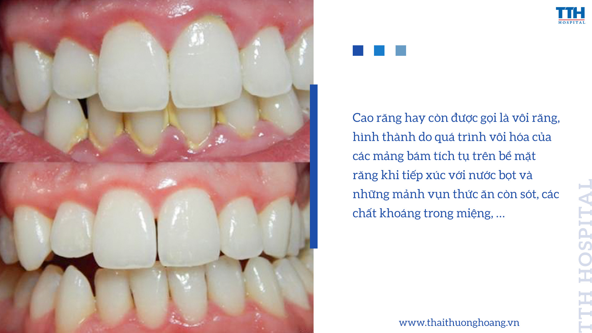 CAO RĂNG HÌNH THÀNH NHƯ THẾ NÀO?