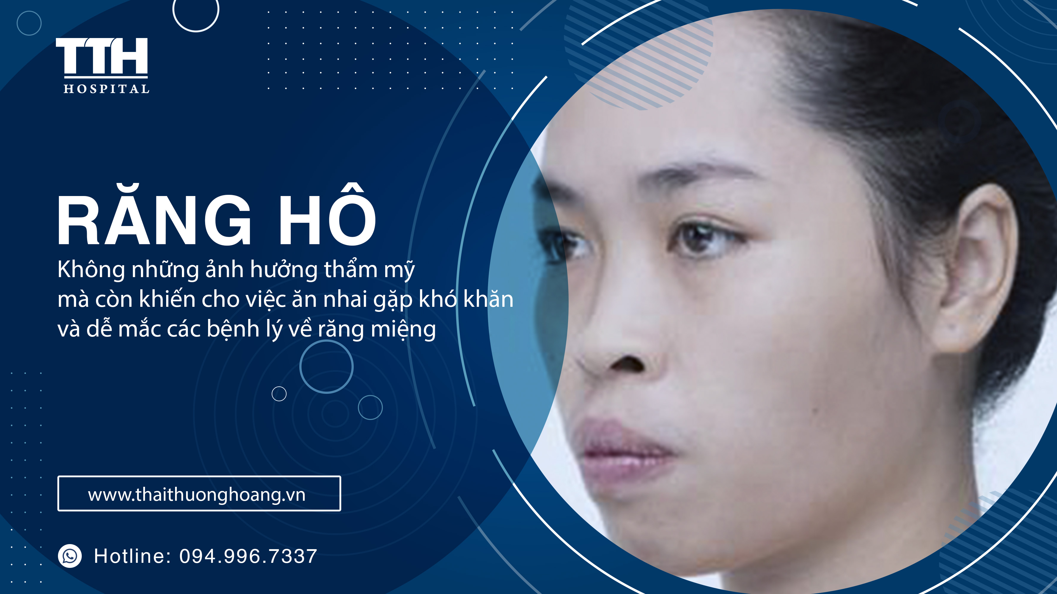 ẢNH HƯỞNG TIÊU CỰC CỦA RĂNG HÔ
