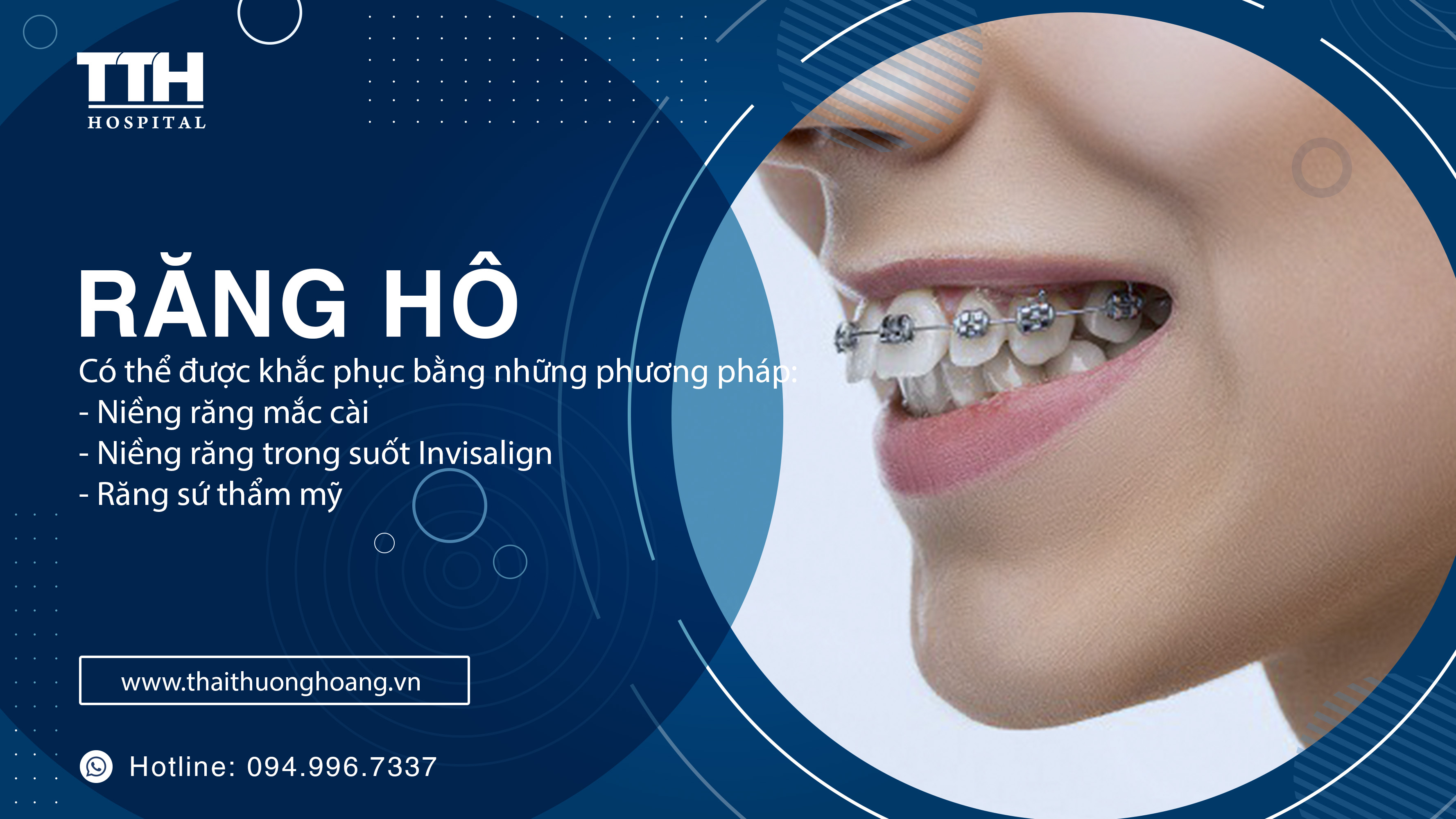 PHƯƠNG PHÁP KHẮC PHỤC RĂNG HÔ
