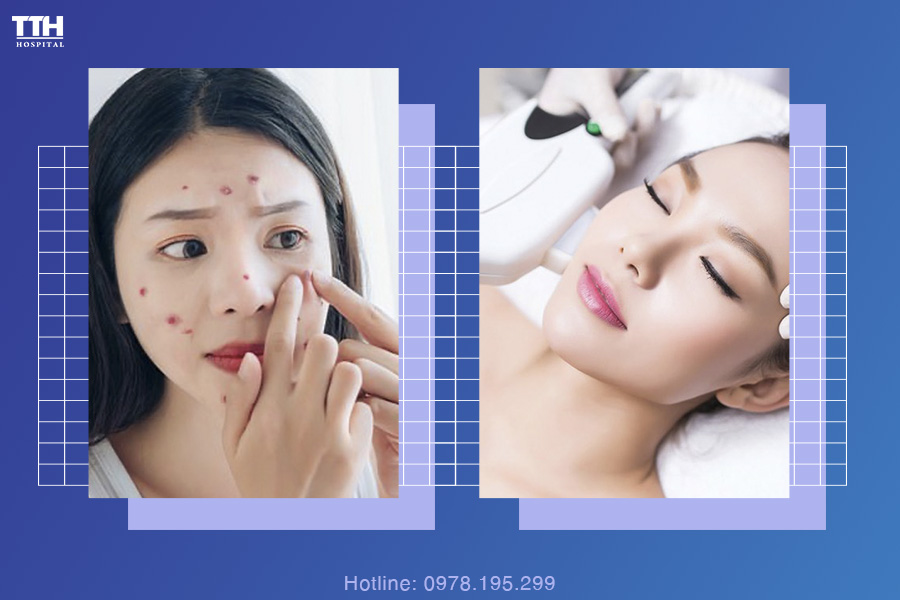 PHƯƠNG PHÁP ĐIỀU TRỊ MỤN VIÊM