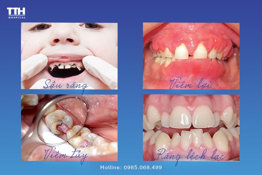 NHỮNG BỆNH LÝ RĂNG MIỆNG THƯỜNG GẶP Ở TRẺ SÂU RĂNG
