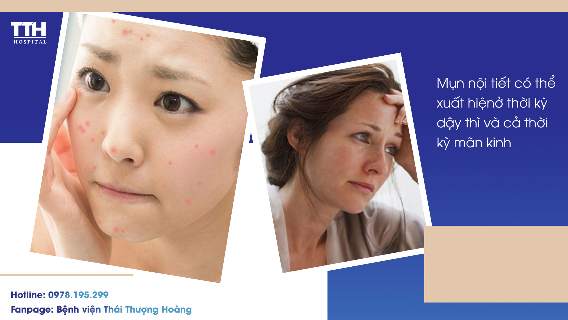 ĐẶC ĐIỂM CỦA MỤN NỘI TIẾT