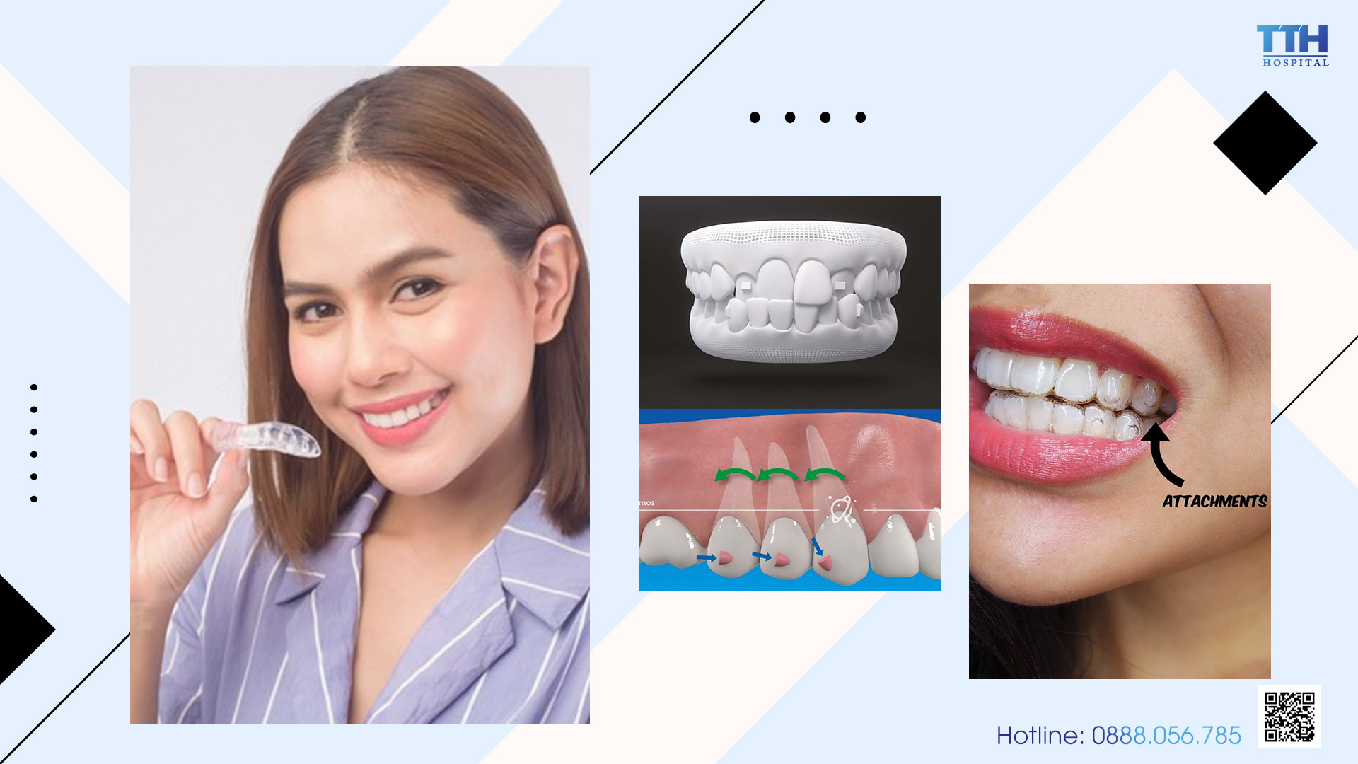 Miếng đệm răng SmartForce giúp quá trình niềng răng tong suốt Invisalign trở nên hiệu quả hơn, đặc biệt là với những trường hợp phức tạp