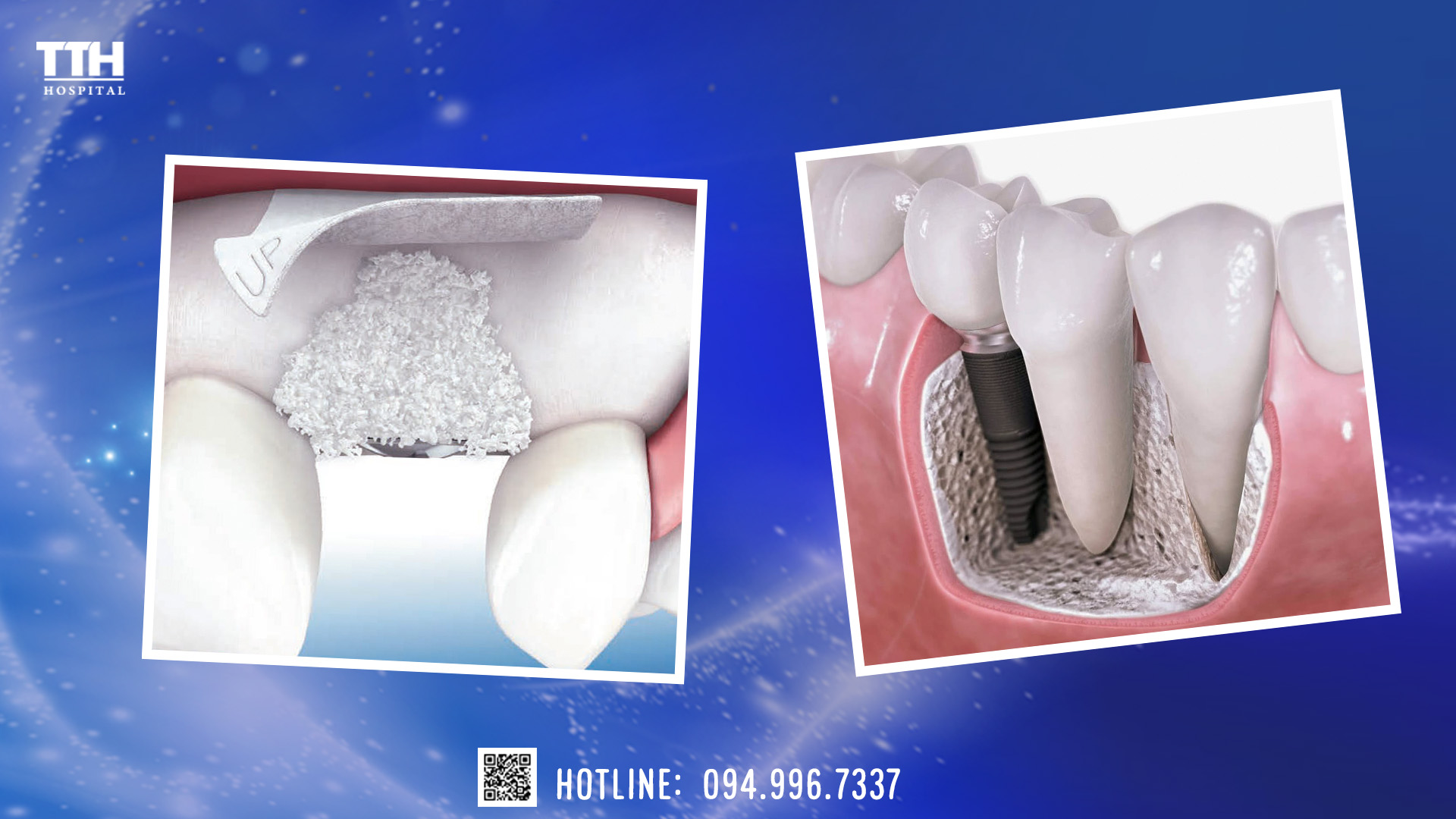 PHẪU THUẬT GHÉP XƯƠNG ĐỂ CẤY GHÉP IMPLANT CÓ NGUY HIỂM KHÔNG?