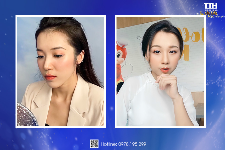 Hình ảnh khách hàng sau khi nâng mũi tại Thái Thượng Hoàng