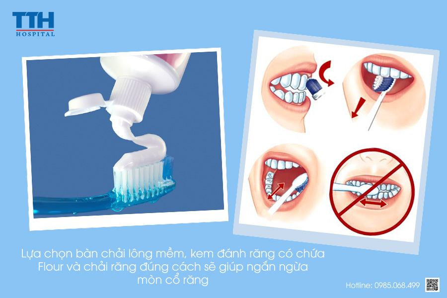 PHÒNG NGỪA MÒN CỔ RĂNG