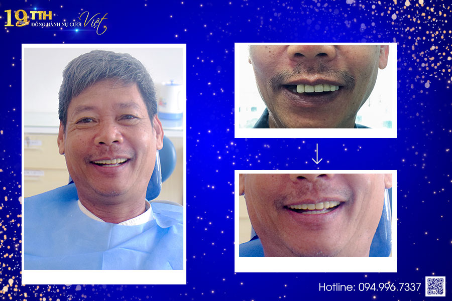ƯU ĐIỂM CỦA PHƯƠNG PHÁP TRỒNG RĂNG IMPLANT