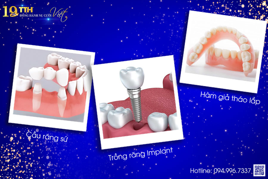 3 PHƯƠNG PHÁP TRỒNG RĂNG GIẢ PHỔ BIẾN