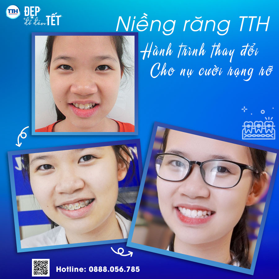 Kết quả khách hàng niềng răng tại Bệnh viện Thái Thượng Hoàng