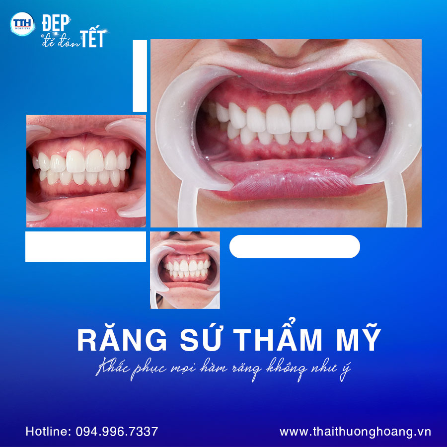 Kết quả khách hàng bọc răng sứ tại Bệnh viện Thái Thượng Hoàng