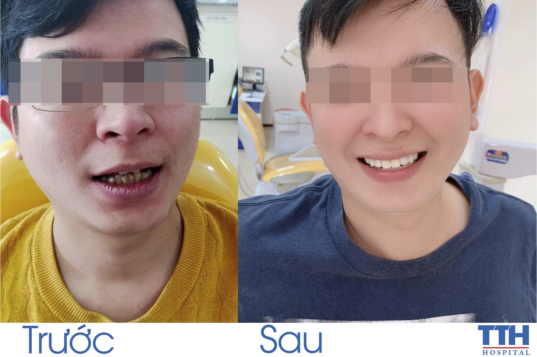 Răng mọc lộn xộn, lệch lạc nhẹ