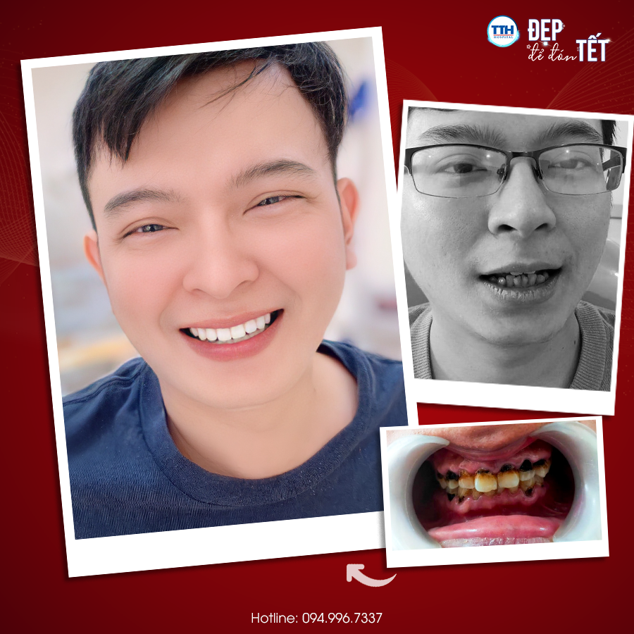 MỘT SỐ CÂU HỎI THƯỜNG GẶP VỀ RĂNG SỨ THẨM MỸ