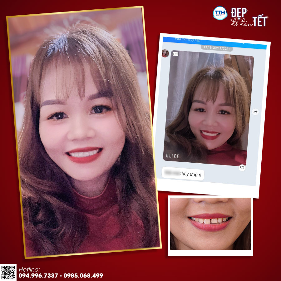 Hình ảnh khách hàng sau răng sứ thẩm mỹ tại Thái Thượng Hoàng