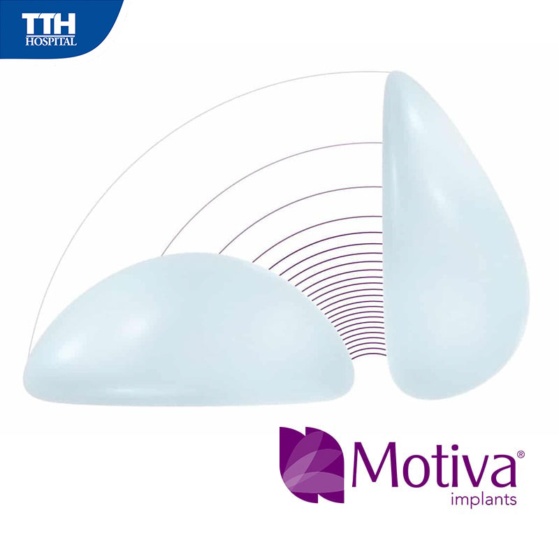Ưu điểm túi ngực Motiva Nano chip Ergonomic