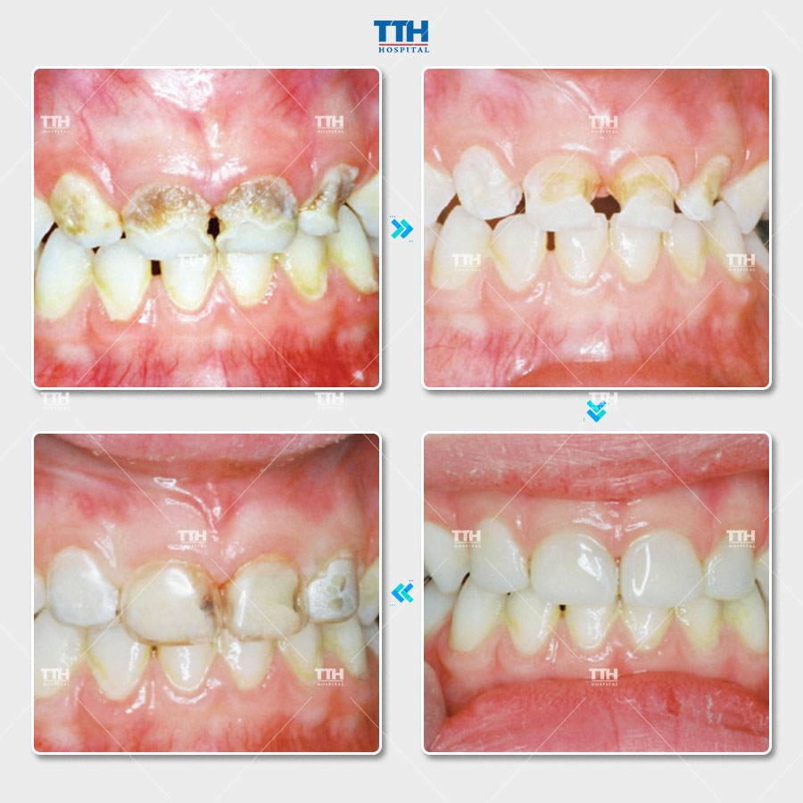 Kết quả sau phục hồi thân răng sữa bằng strip crown tại TTH