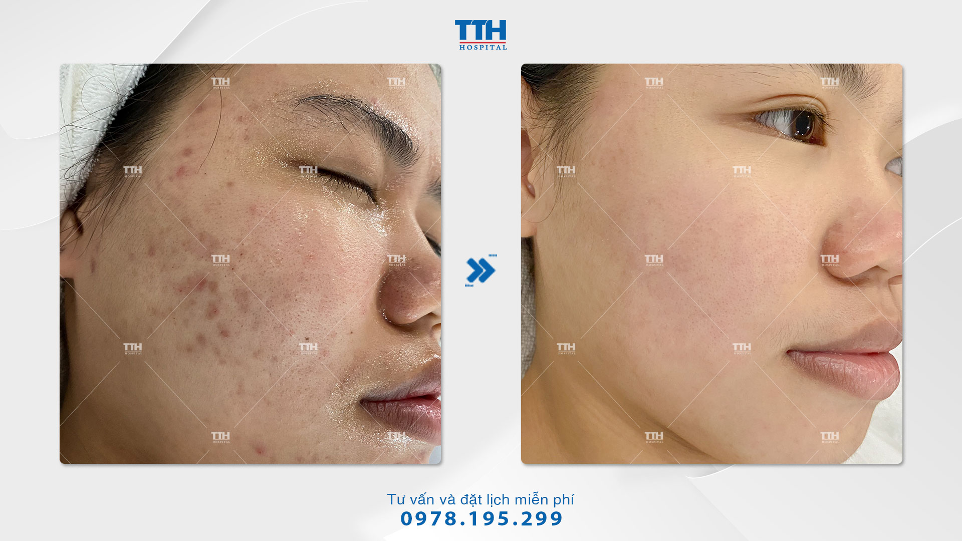 Kết quả điều trị mụn Chemical Peel tại Bệnh viện Thái Thượng Hoàng