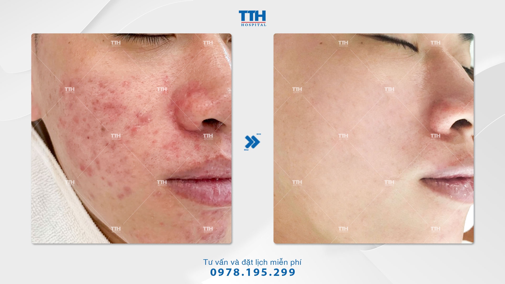 Hình ảnh kết quả của khách hàng sau điều trị mụn viêm bằng công nghệ ánh sáng sinh học IPL kết hợp Chemical Peel tại Bệnh viện Thái Thượng Hoàng