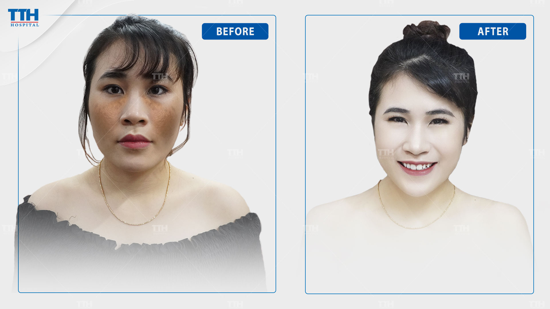 Kết quả điều trị nám của khách hàng tại Bệnh viện Thái Thượng Hoàng