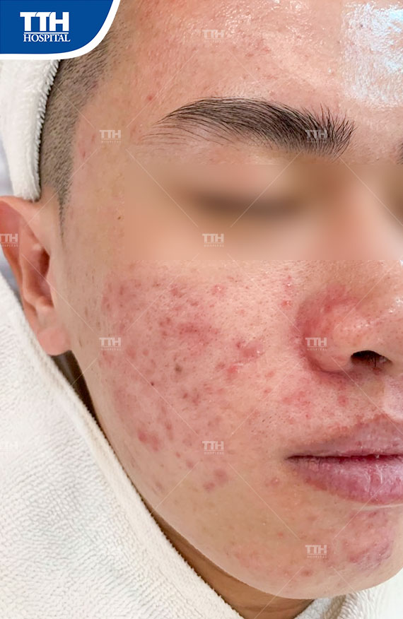 Mụn viêm là dạng nặng của mụn trứng cá với biểu hiện là những nốt mụn sưng đỏ, có cảm giác đau nhức xuất hiện trên da