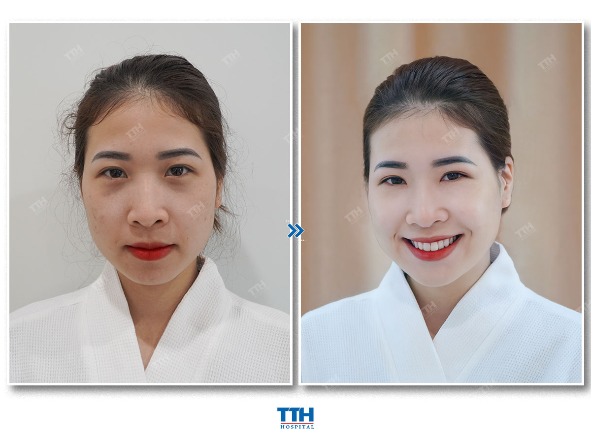 Ngăn ngừa lão hóa hiệu quả với Hyaluronic acid - HA