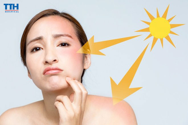 Ánh nắng mặt trời là một trong những tác nhân khiến làn da lão hóa nhanh chóng hơn
