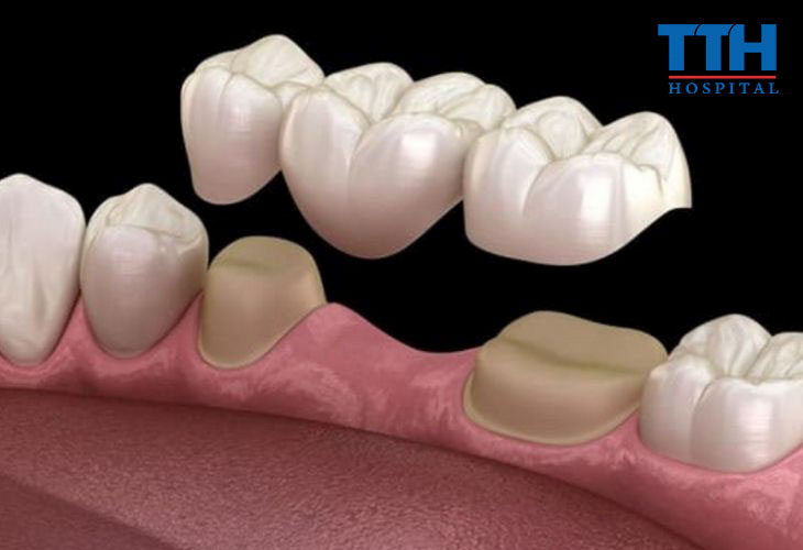 Cách khắc phục hiệu quả cho tình trạng mất răng hàm