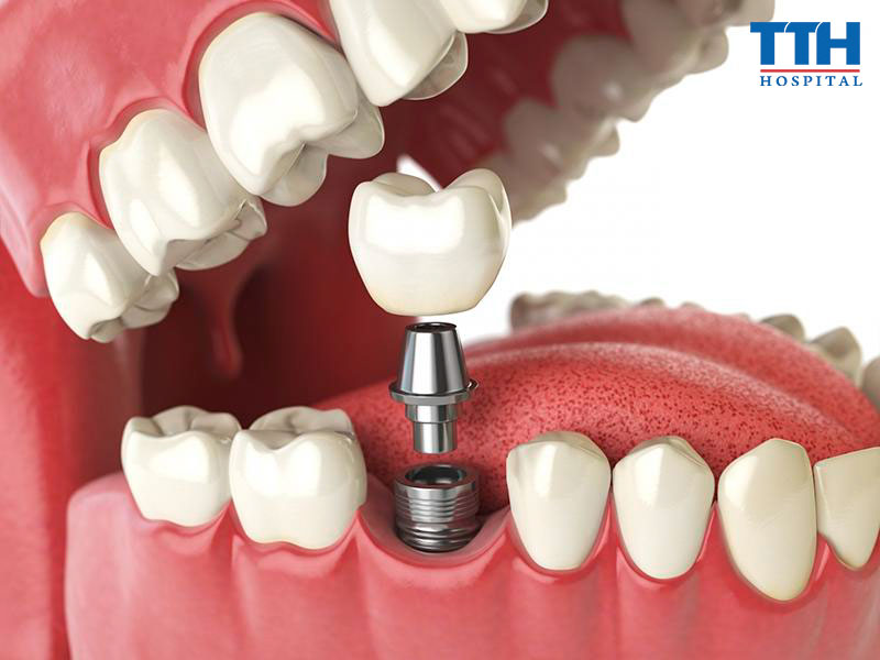 Trồng răng Implant