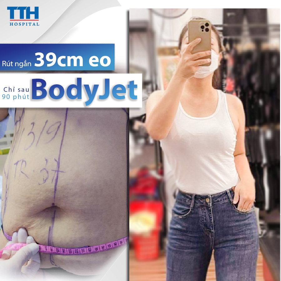 Có nên hút mỡ bụng sau sinh không?