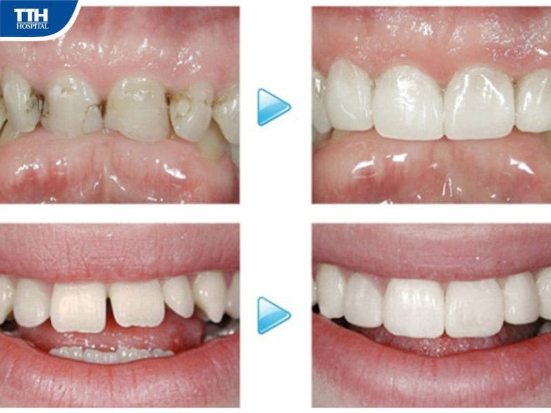 4 phương pháp điều trị răng thưa hiệu quả