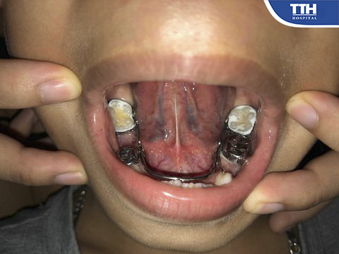 Đai giữ khoảng giúp duy trì khoảng trống, hướng dẫn răng vĩnh viễn mọc đúng vị trí