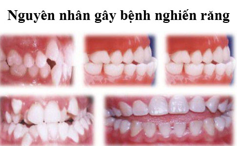 Sự lệch lạc của các răng: Khi các răng hàm trên và hàm dưới mọc lệch lạc, không ăn khớp với nhau thì khi ngủ do vô thức 2 hàm răng sẽ cọ sát vào nhau, nghiến chặt lại.