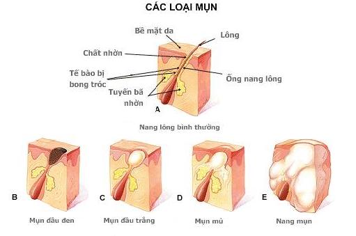 Các loại mụn