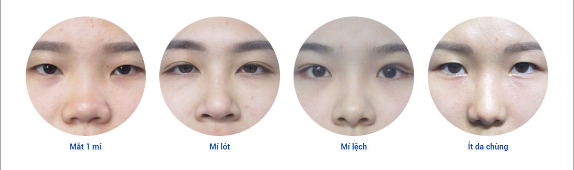 Phẫu thuật cắt mí mắt nên được thực hiện trong trường hợp nào?