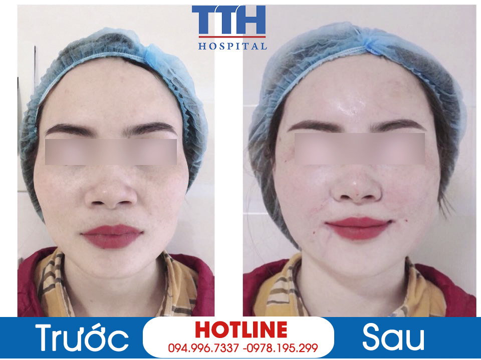 Phương pháp cấy mỡ Baby Face mang nhiều ưu điểm vượt trội hơn so với các phương pháp làm đầy khác