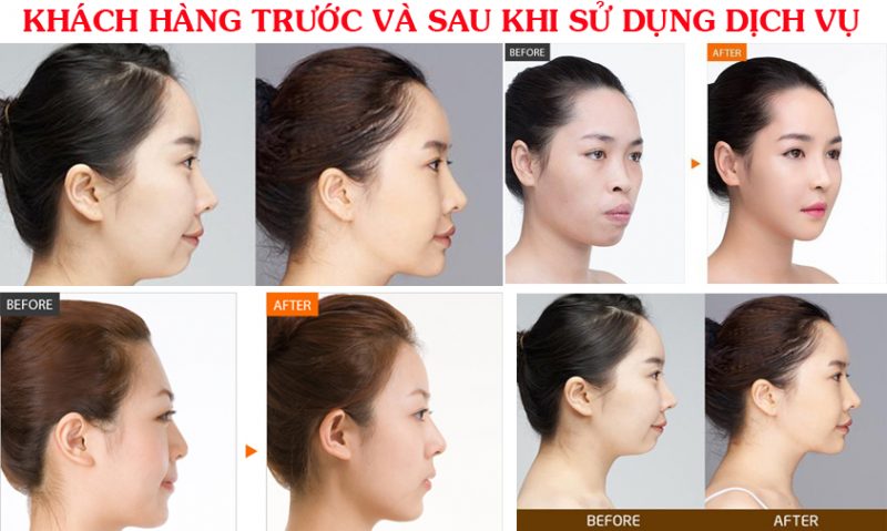 CHĂM SÓC SAU PHẪU THUẬT ĐỘN TRÁN